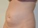 Tummy Tuck Before Patient Thumbnail 2