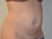 Tummy Tuck Before Patient Thumbnail 4