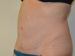 Tummy Tuck After Patient Thumbnail 2