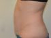 Tummy Tuck After Patient Thumbnail 3