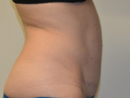 Tummy Tuck After Patient 5