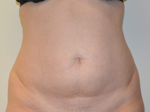 Tummy Tuck Before Patient 1