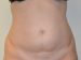 Tummy Tuck Before Patient Thumbnail 1