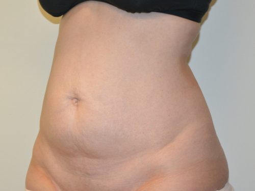 Tummy Tuck Before Patient 4