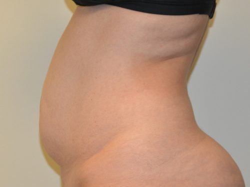 Tummy Tuck Before Patient 5