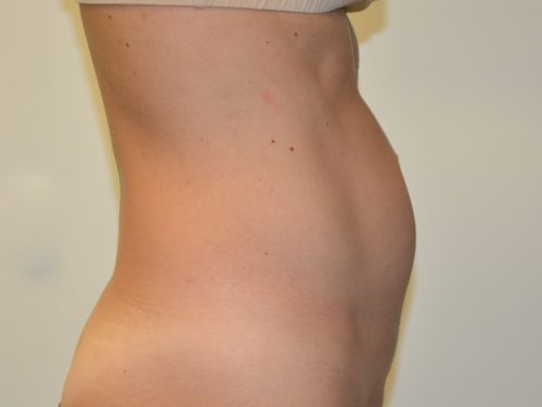 Mini Tummy Tuck Before Patient 3