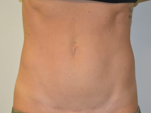 Mini Tummy Tuck After Patient 1