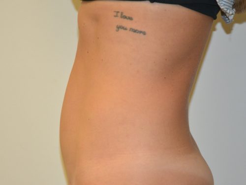 Mini Tummy Tuck After Patient 5