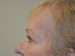 Eyelid Surgery Before Patient Thumbnail 3