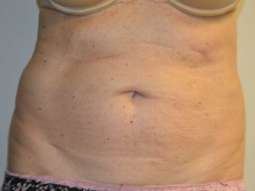 Coolsculpting Before Patient 1