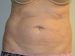 Coolsculpting Before Patient Thumbnail 1