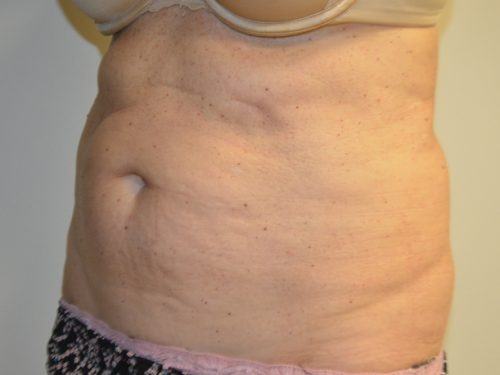 Coolsculpting Before Patient 2