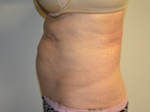 Coolsculpting Before Patient 3