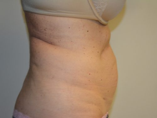 Coolsculpting Before Patient 5