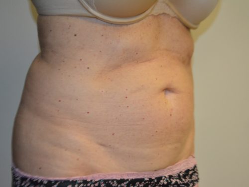 Coolsculpting Before Patient 4