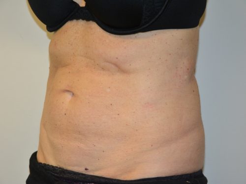 Coolsculpting After Patient 2