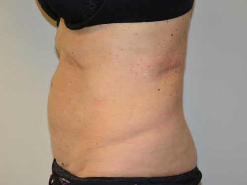 Coolsculpting After Patient 3