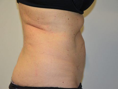 Coolsculpting After Patient 5