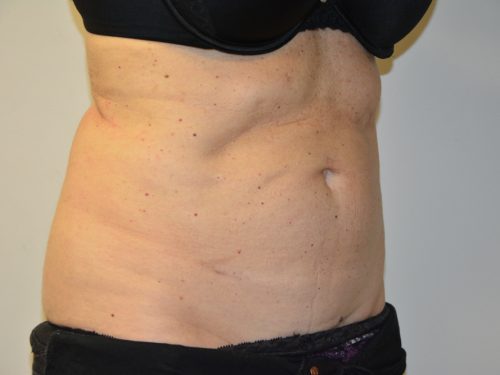 Coolsculpting After Patient 4