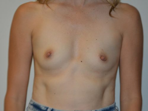 Breast Augmentation Before Patient 1