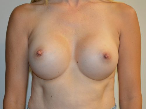 Breast Augmentation After Patient 1