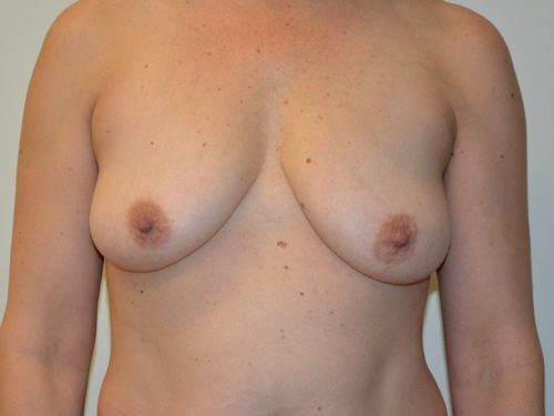 Breast Lift Before Patient 1