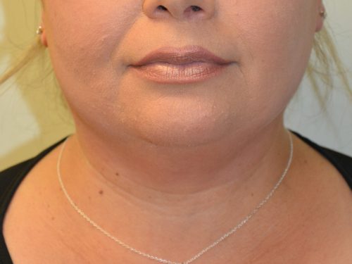 Neck Liposuction Before Patient 1