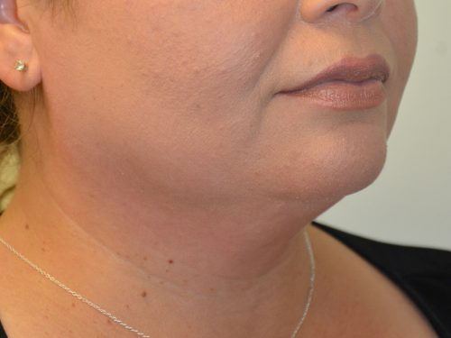 Neck Liposuction Before Patient 2