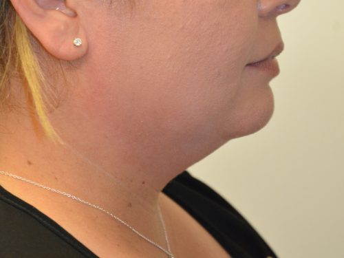 Neck Liposuction Before Patient 3