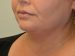 Neck Liposuction Before Patient Thumbnail 4