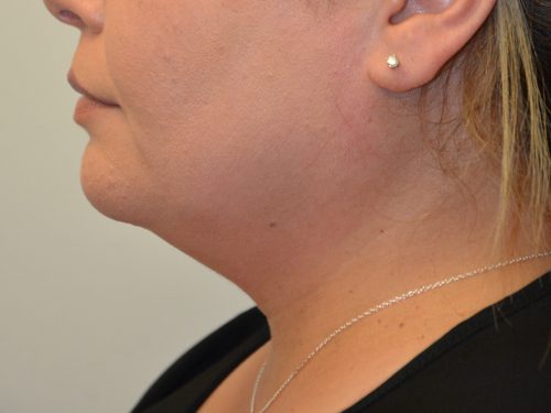 Neck Liposuction Before Patient 5