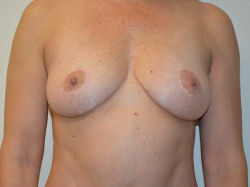 Breast Lift After Patient 1