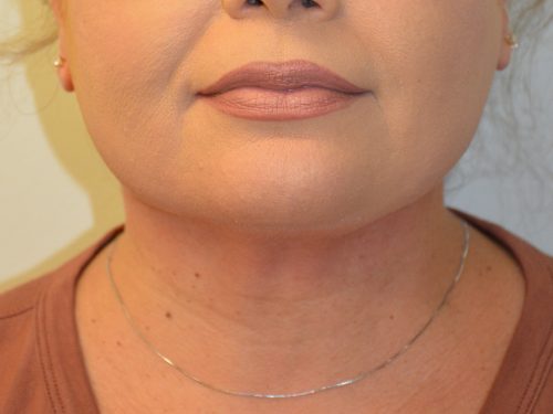 Neck Liposuction After Patient 1