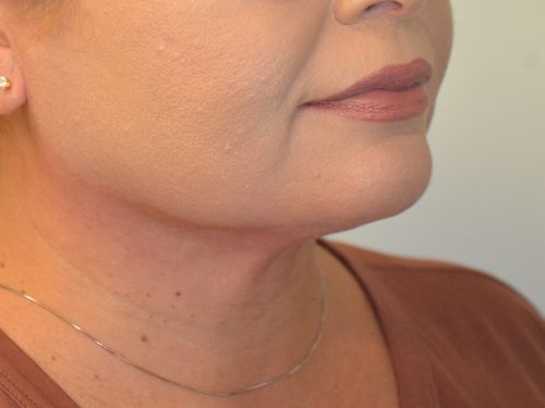 Neck Liposuction After Patient 2