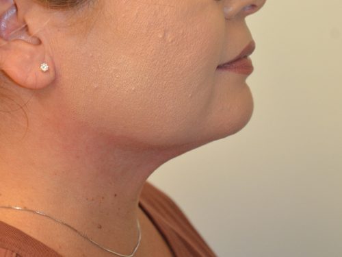 Neck Liposuction After Patient 3