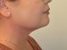 Neck Liposuction After Patient Thumbnail 3