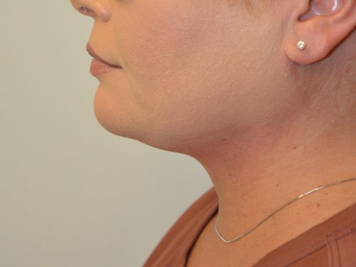 Neck Liposuction After Patient 5