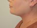 Neck Liposuction After Patient Thumbnail 5