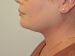 Neck Liposuction After Patient Thumbnail 5