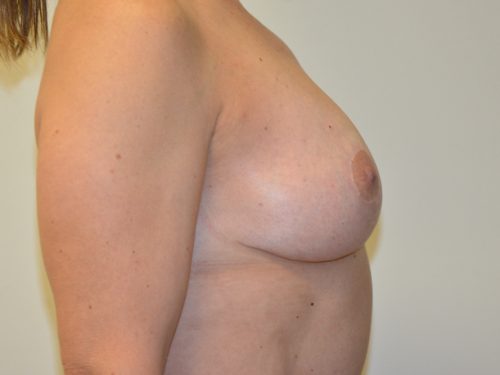 Breast Lift After Patient 5