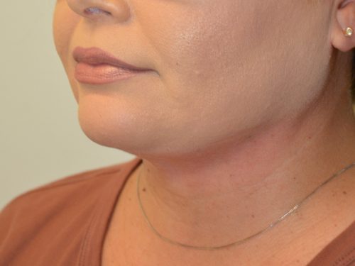 Neck Liposuction After Patient 4