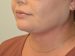 Neck Liposuction After Patient Thumbnail 4