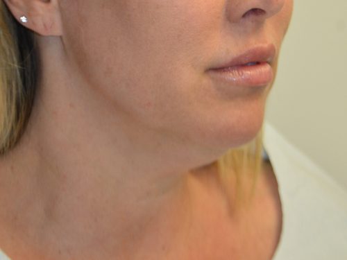 Neck Liposuction Before Patient 2