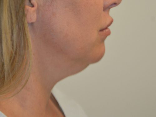 Neck Liposuction Before Patient 1