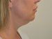 Neck Liposuction Before Patient Thumbnail 1