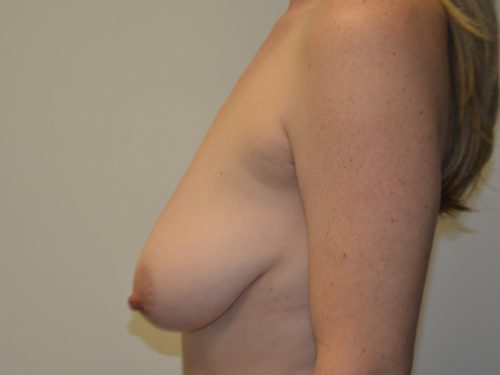 Breast Lift Before Patient 5