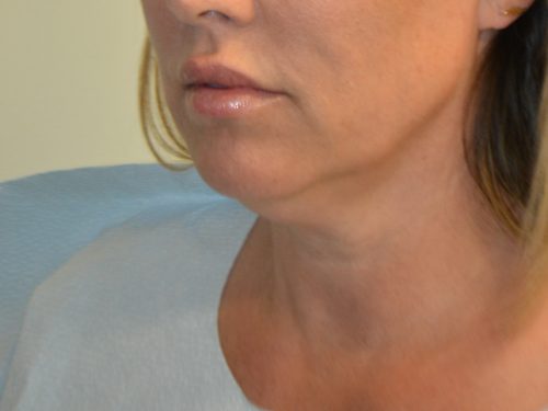 Neck Liposuction Before Patient 3