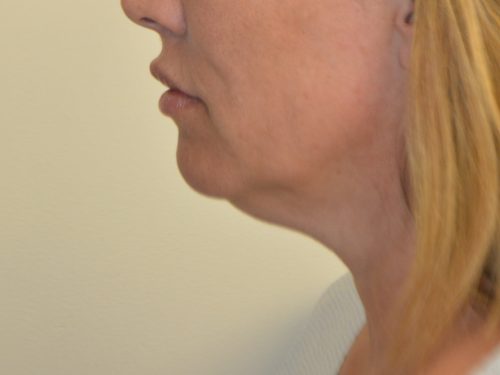 Neck Liposuction Before Patient 4