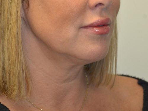 Neck Liposuction After Patient 2