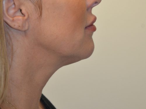 Neck Liposuction After Patient 1